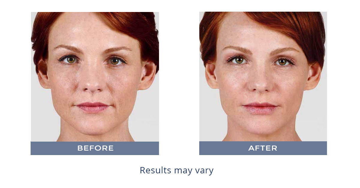 Juvederm Ultra XC