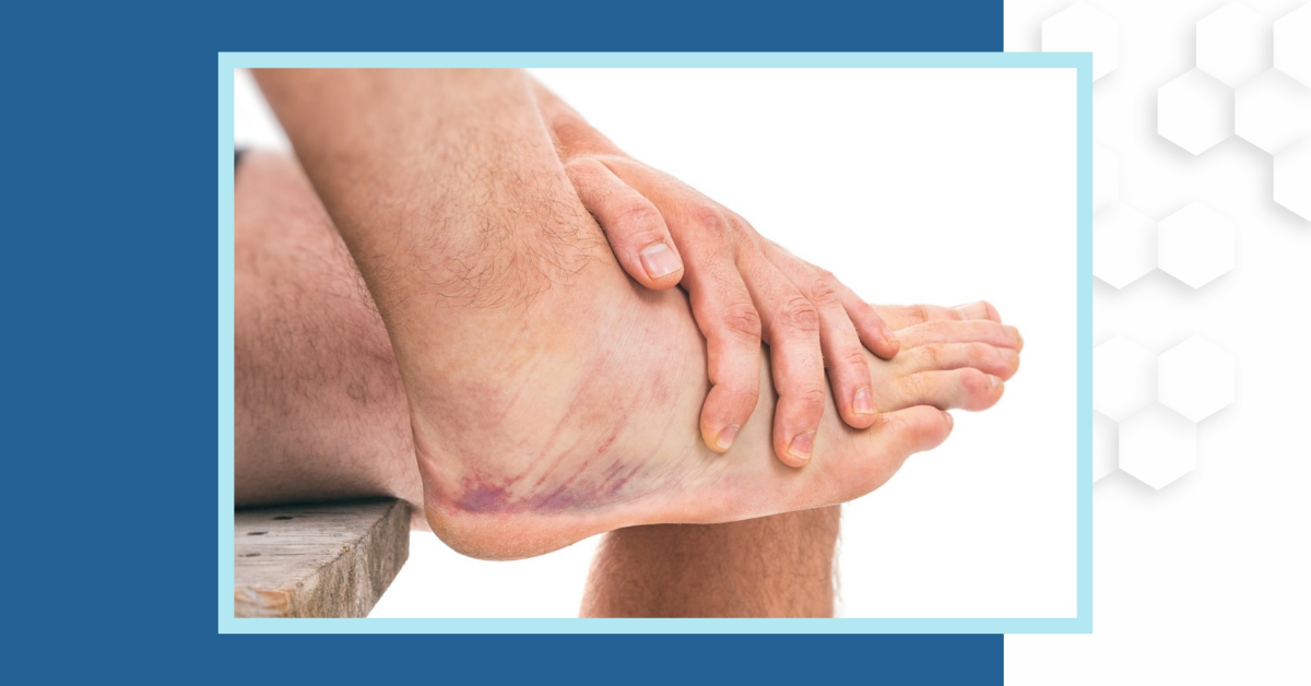 A man holds his ankle as it heals from an ankle sprain