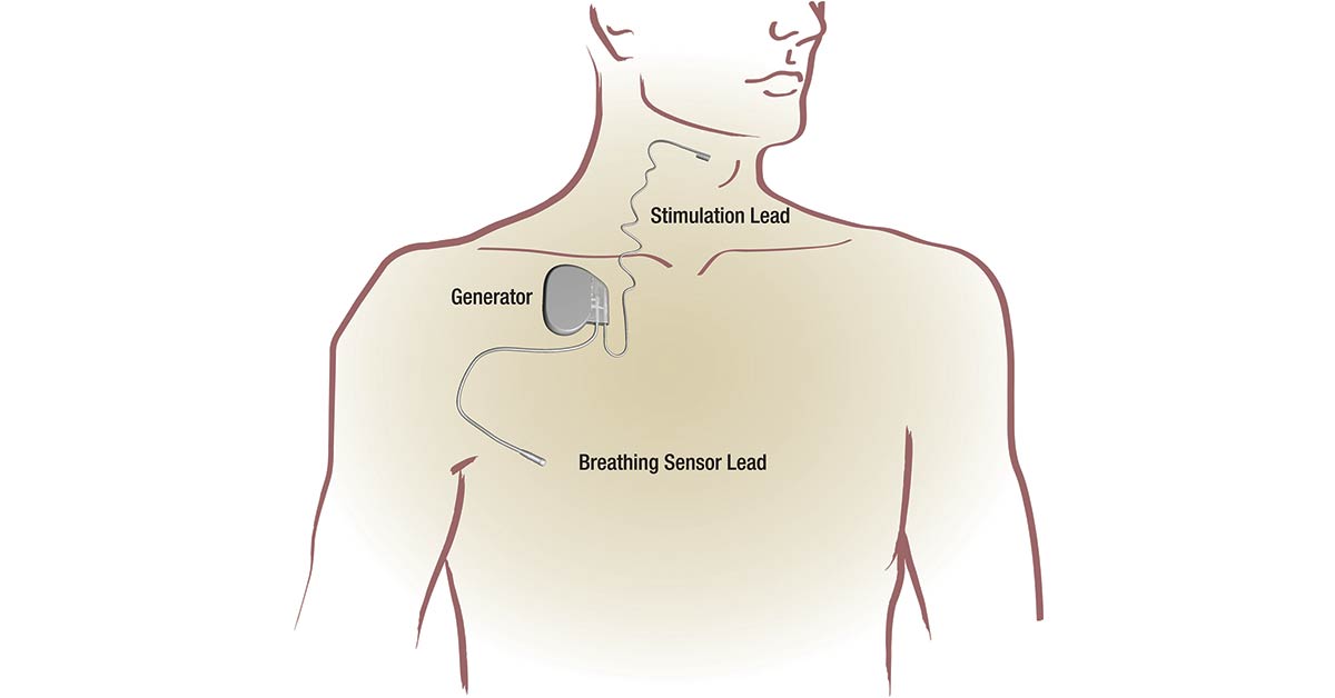 Inspire sleep apnea overview - how it works